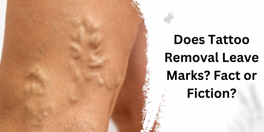 Does Tattoo Removal Leave Marks